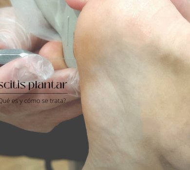 fascitis plantar